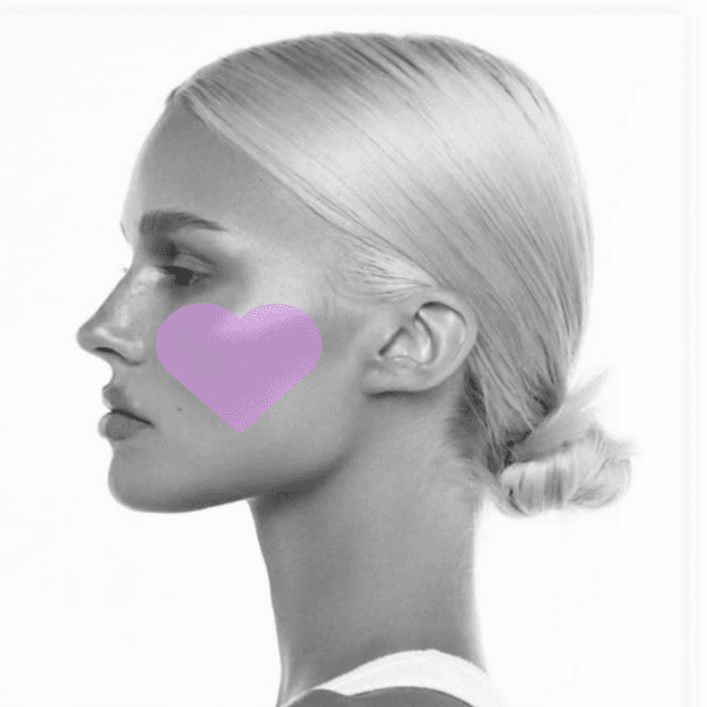 Cheeks Laser Hair Removal (3PK) at The Skin Addict by Megan in White Plains, NY