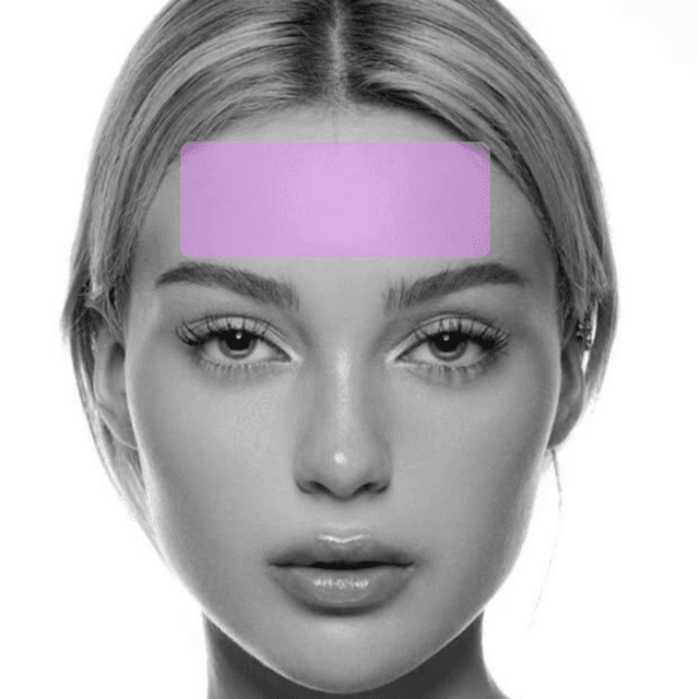 Forehead Laser Hair Removal (3PK) at The Skin Addict by Megan in White Plains, NY
